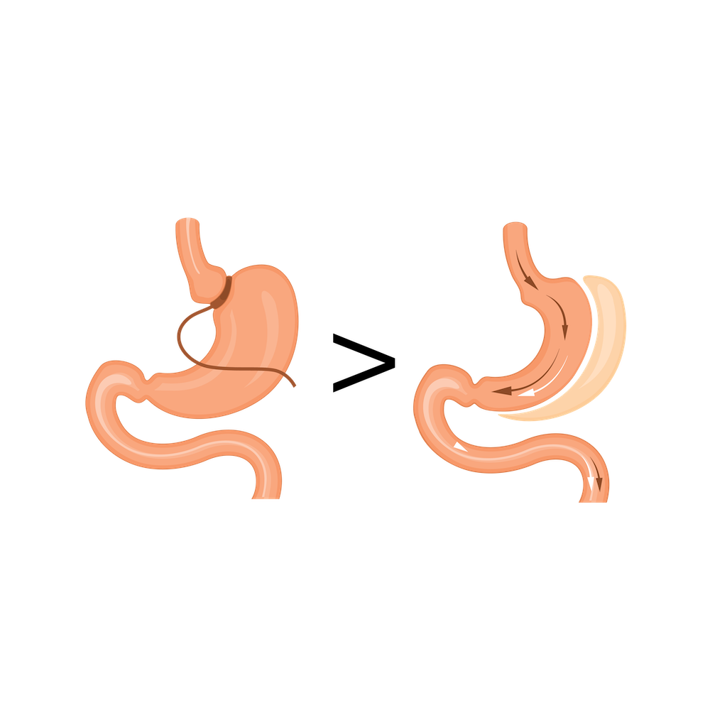 Graphic of Bariatric Revision going from lap band to gastric sleeve.