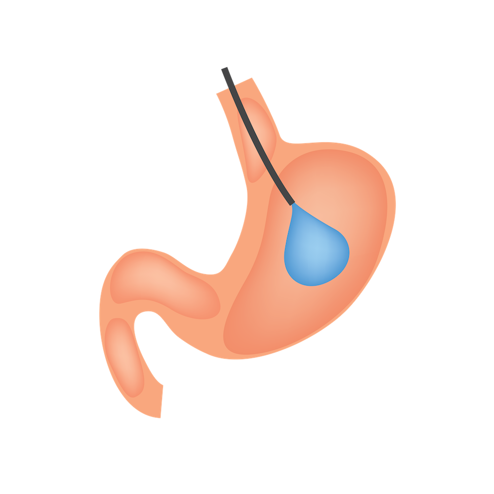 Graphic of Gastric Balloon