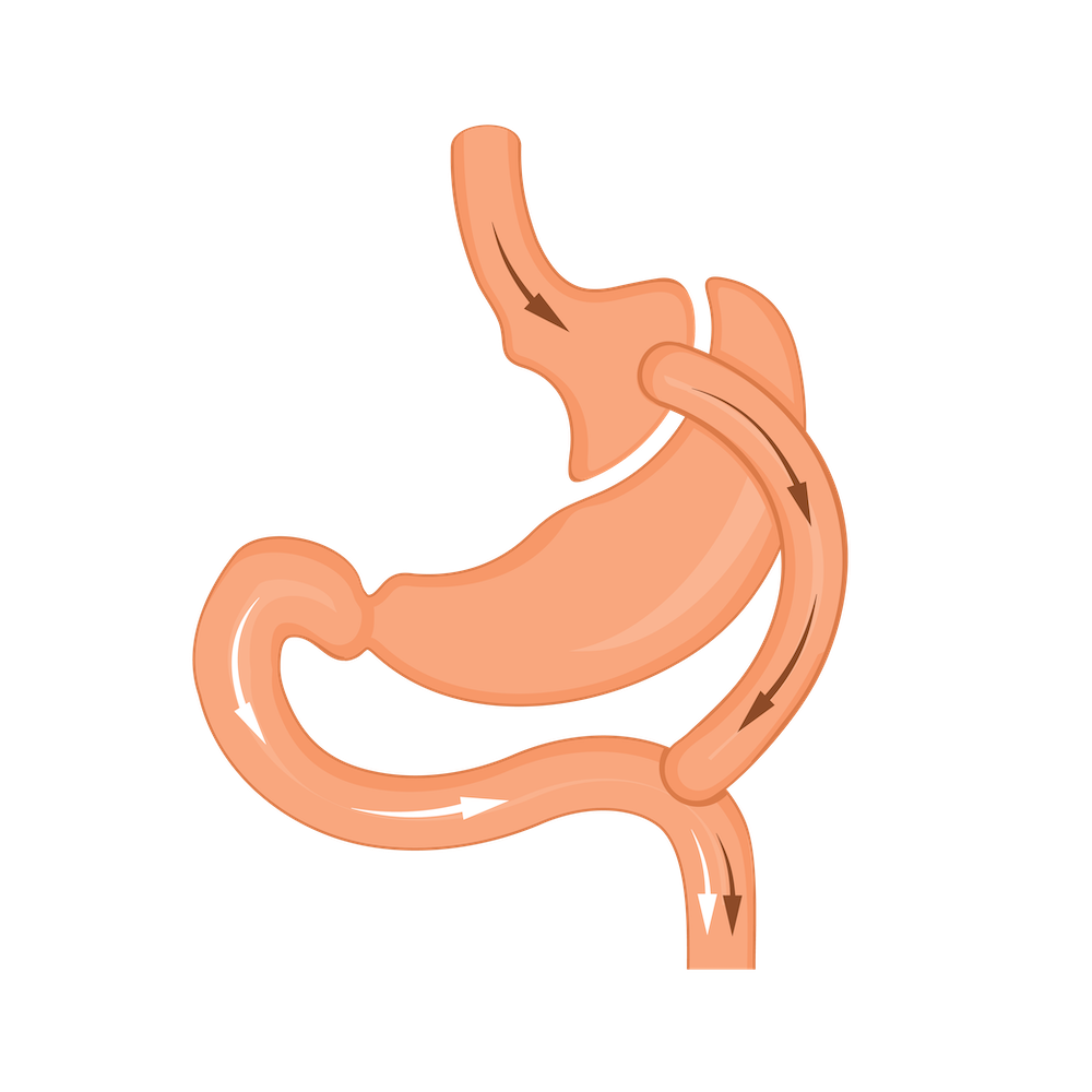 Graphic of Gastric Bypass