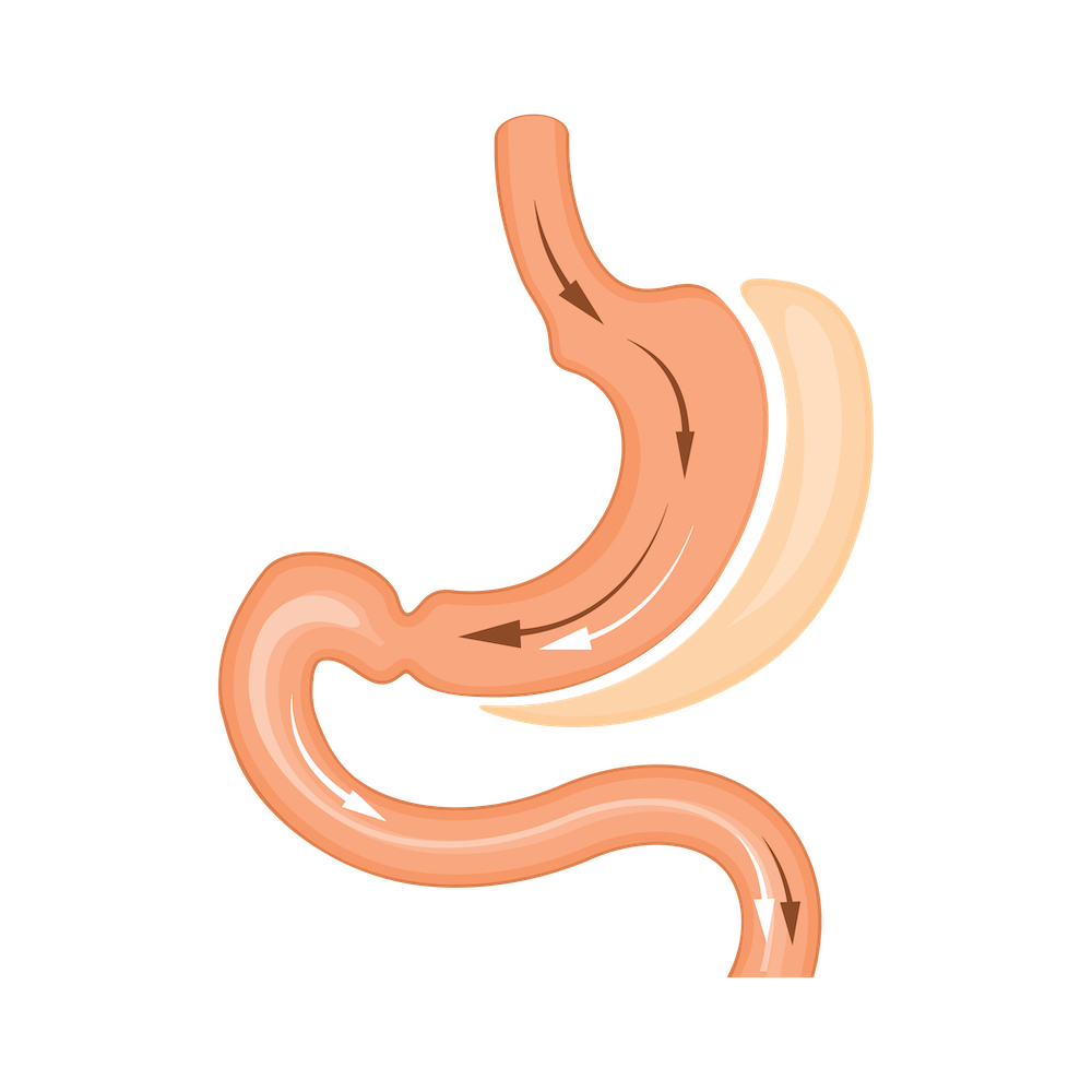 Graphic of Gastric Sleeve