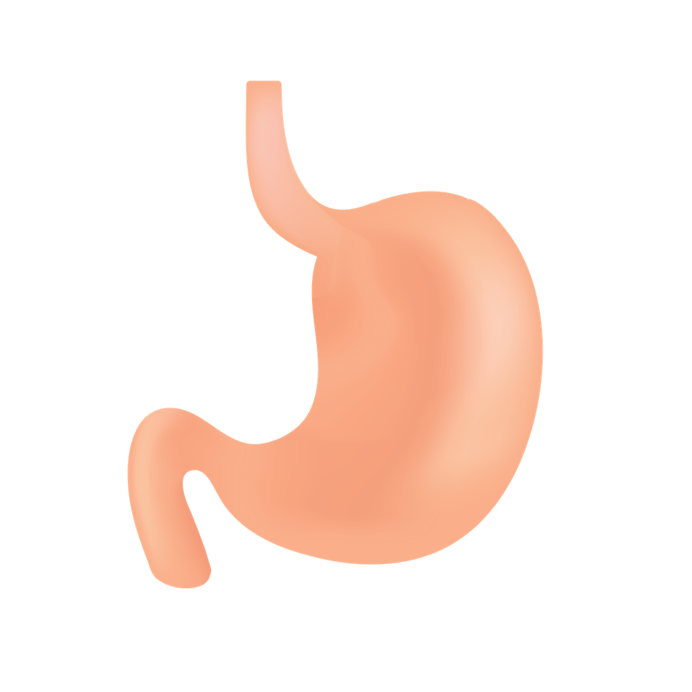 Graphic of Gastric Plication