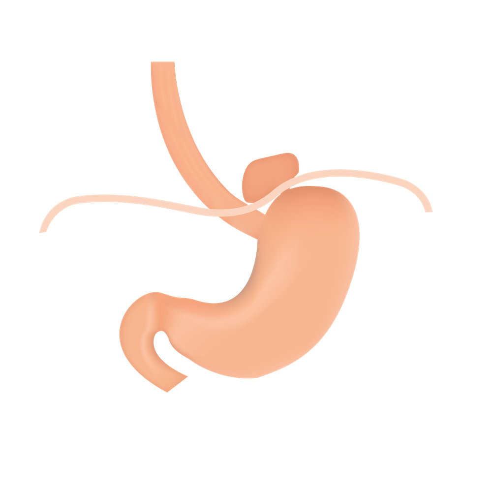 Graphic showing hiatal hernia