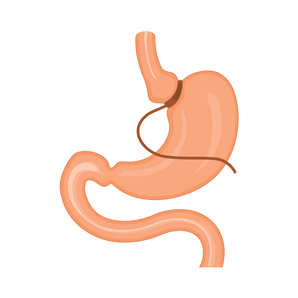 Graphic of Lap Band Procedure