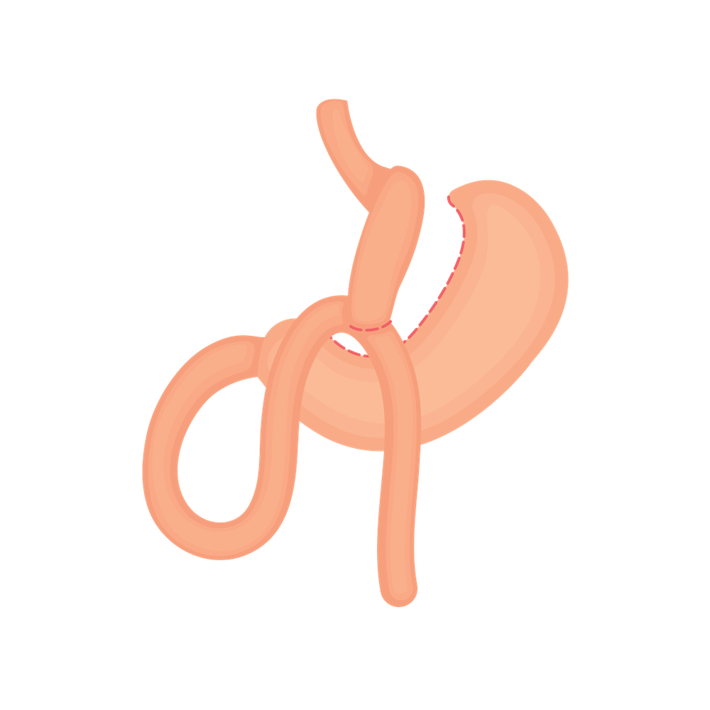 Graphic of Mini Gastric Bypass