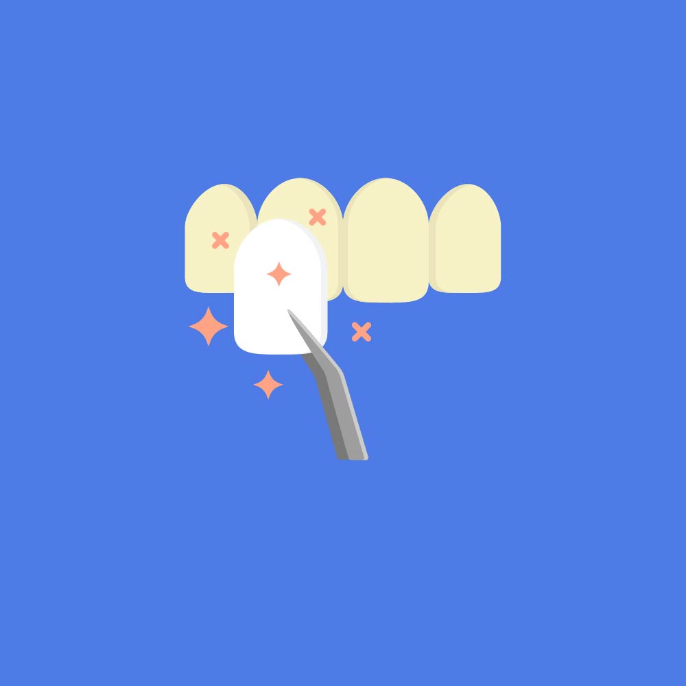 Dental Veneers icon showing veneer overlaying tooth.