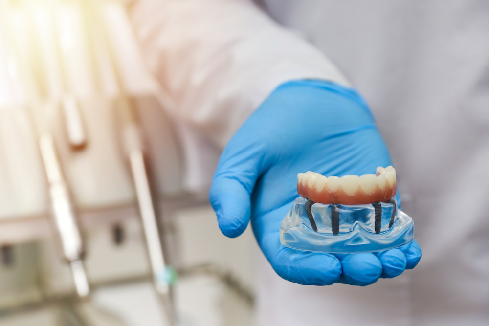 Dentist holding model of all on 4 implants in jaw with full set of teeth.