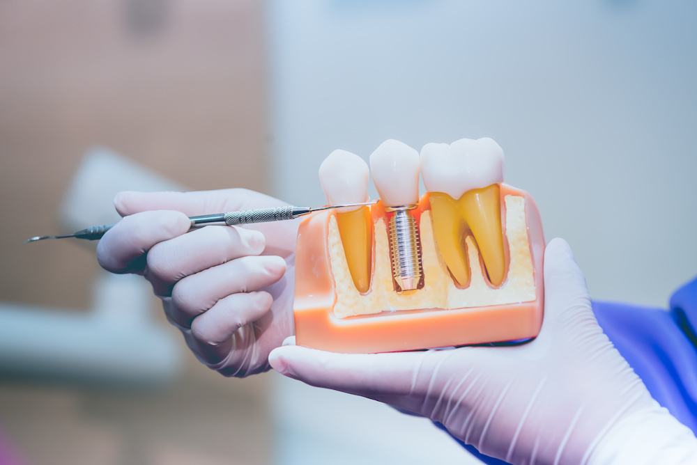 Dentist showing model of single tooth implant to patient. Includes showing screw, crown and gumline.