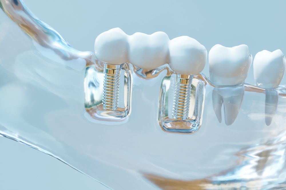 Multi Tooth Implant showing screws into jaw.