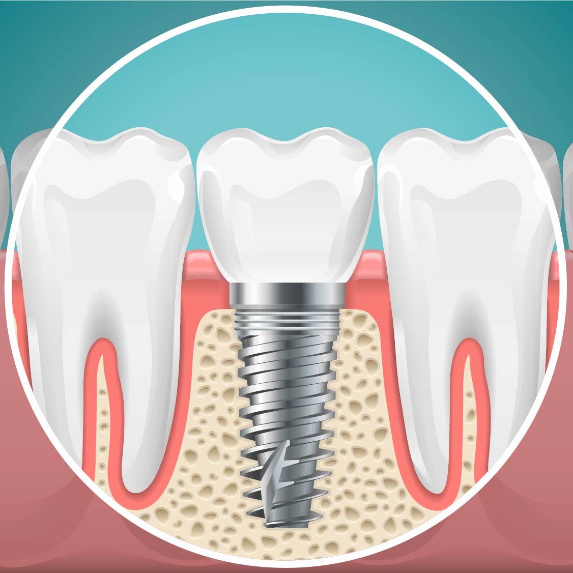 3D rendering of Osseointegration, metal screw holding tooth fusing with bone.