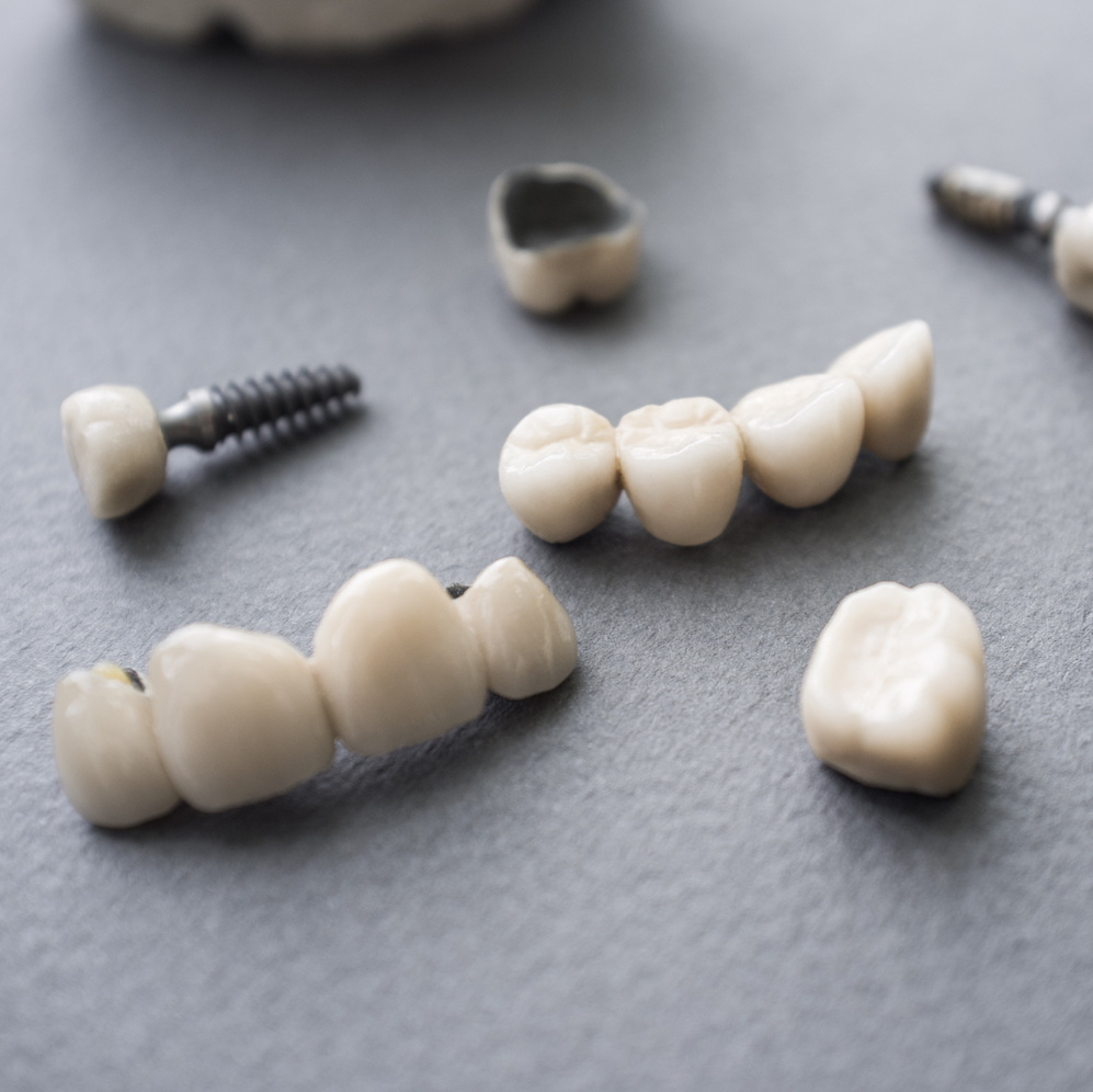 Single and Multi Teeth Implants laying on table.